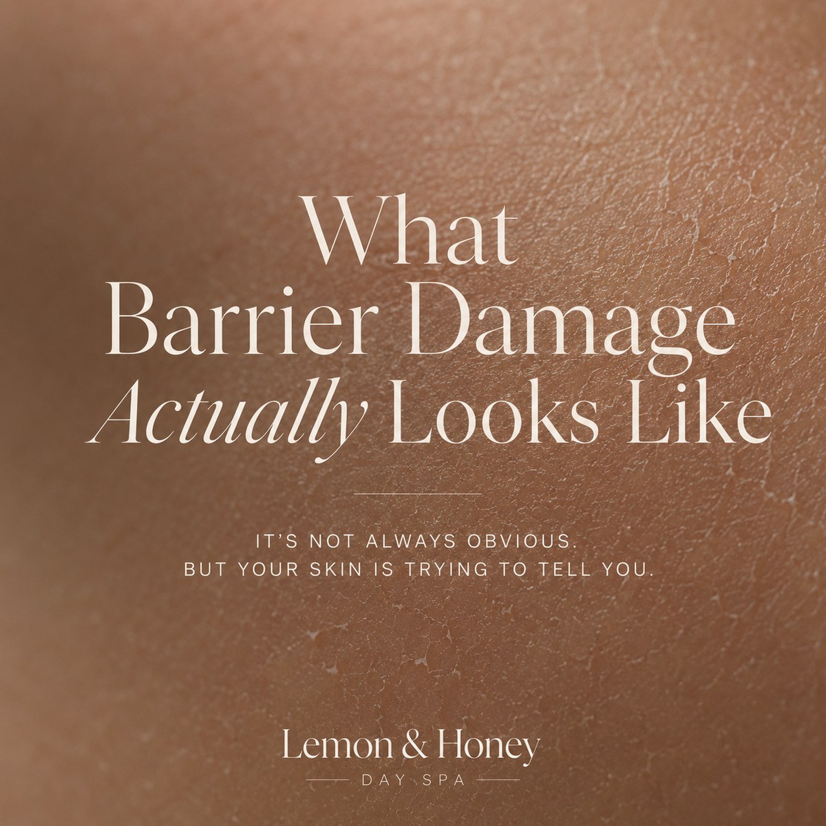 What barrier damage actually looks like, dry flaky compromised skin, Lemon & Honey Day Spa in Orange County