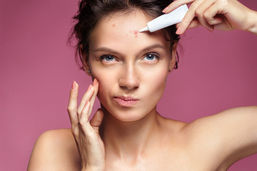 A woman with acne on her face applying a treatment.