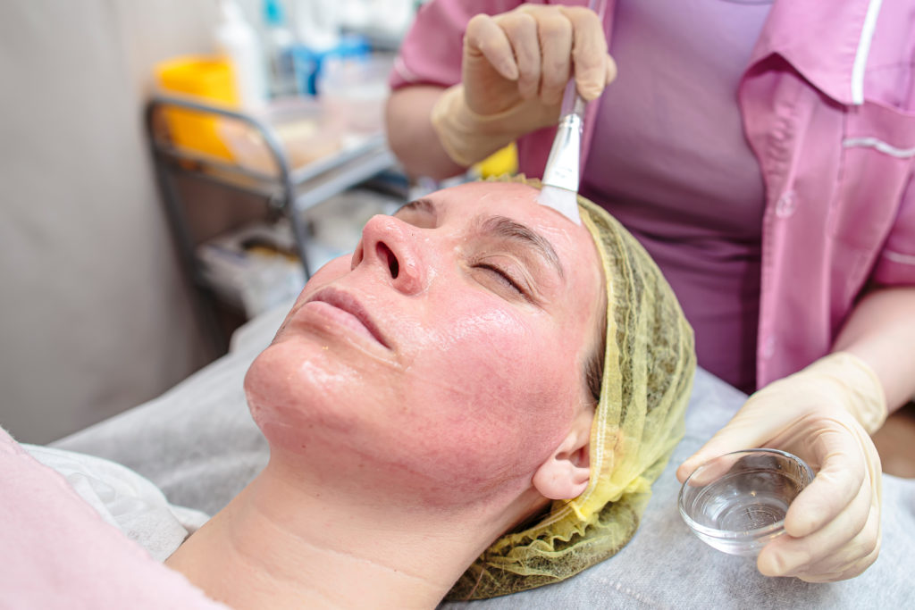chemical peel for acne scars